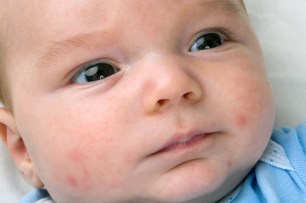 Yuk, Kenali IgE dan Kaitannya dengan Alergi Anak