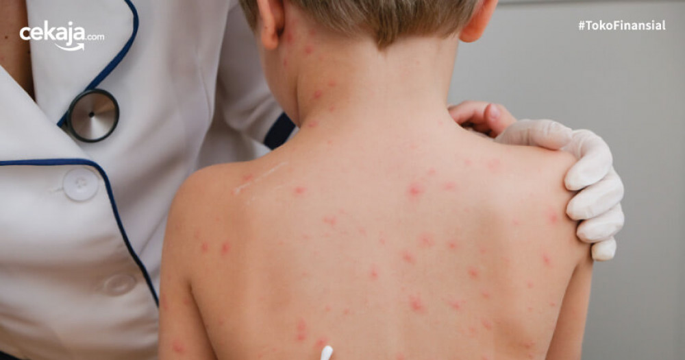 Cacar Monyet pada Bayi: Gejala, Pencegahan, dan Pengobatan