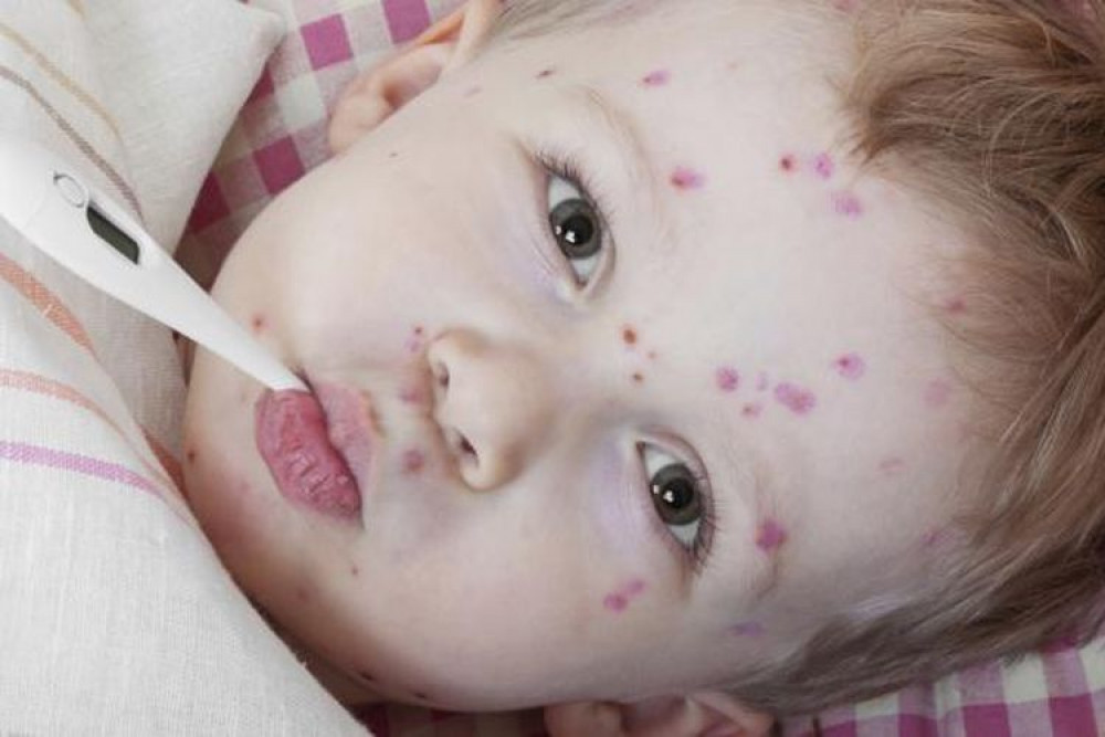 Gejala dan Cara Mengobati Cacar Air Pada Anak