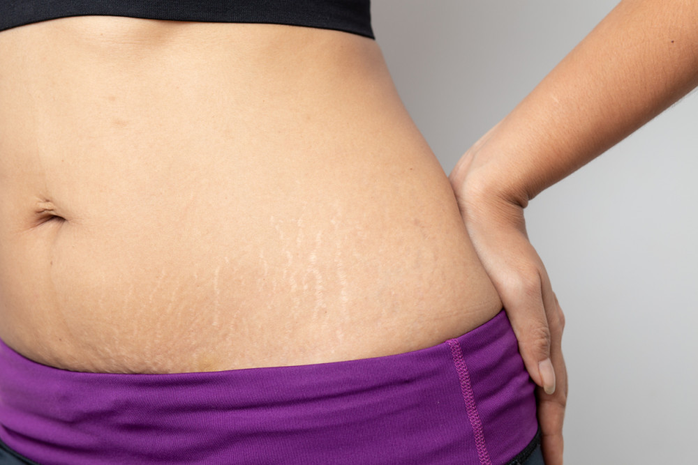 Penyebab Stretch Mark dan Cara Menghilangkan Secara Alami