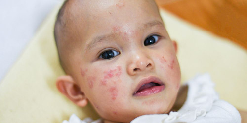 9 Penyebab Pipi Bayi Merah Dan Kasar Beserta Cara Mengatasinya Prenagen